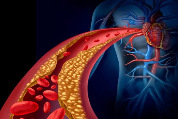 colesterol-alto-guia-prevencao-gerenciamento